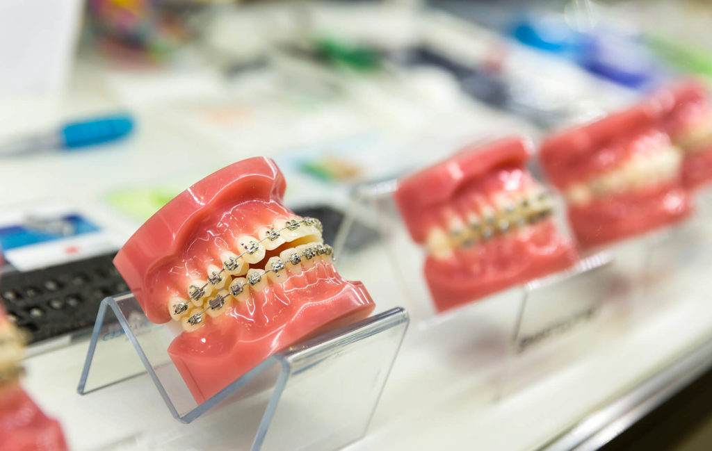 Leczenie ortodontyczne - aparat na zęby