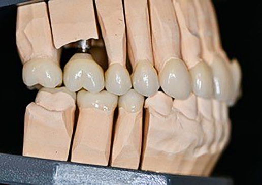 Prodent_Stomatologia_Dentysta_Gdansk_Prodent_Stomatologia_Dentysta_Gdansk_implantoprotetyka_2.jpg