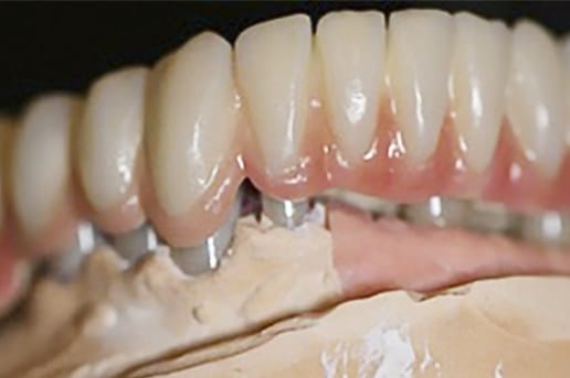 Prodent_Stomatologia_Dentysta_Gdansk_Prodent_Stomatologia_Dentysta_Gdansk_implantoprotetyka_4 copy.jpg
