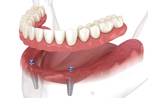 Prodent_Stomatologia_Dentysta_Gdansk_proteza overdenture na dwo╠üch implantach.jpg