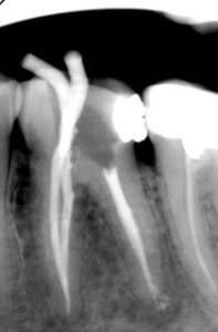x-ray of a tooth PRODENT Gdansk