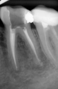 x-ray of a tooth PRODENT Gdansk