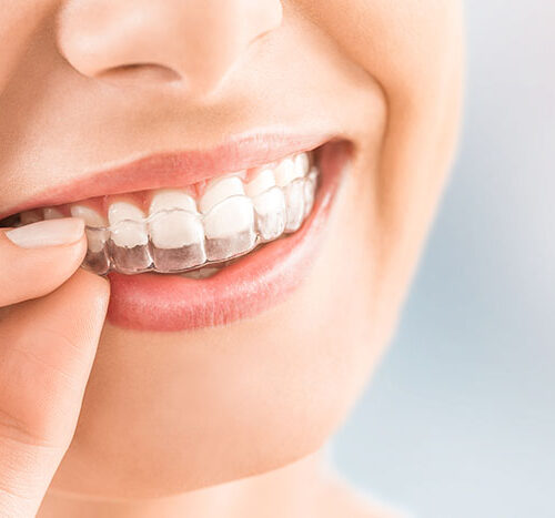 Invisalign gdańsk