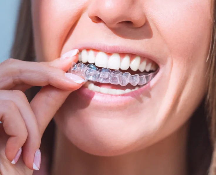 Invisalign nakładkai na zeby gdansk 1