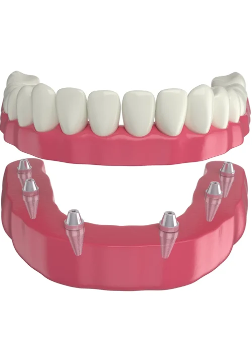 PROTEZA NA IMPLANTACH