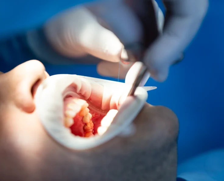 scaling i piaskowanie gdansk dentysta