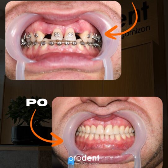 Metamorfoza 5 ProDent