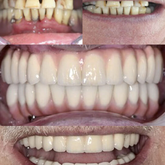 implantacje natychmiastową w żuchwie wraz z jednoczesnym przykręcanym mostem tymczasowym na implantach -rozwiazanie typu „all on six „