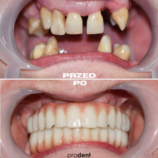 metamorfoza 11 prodent