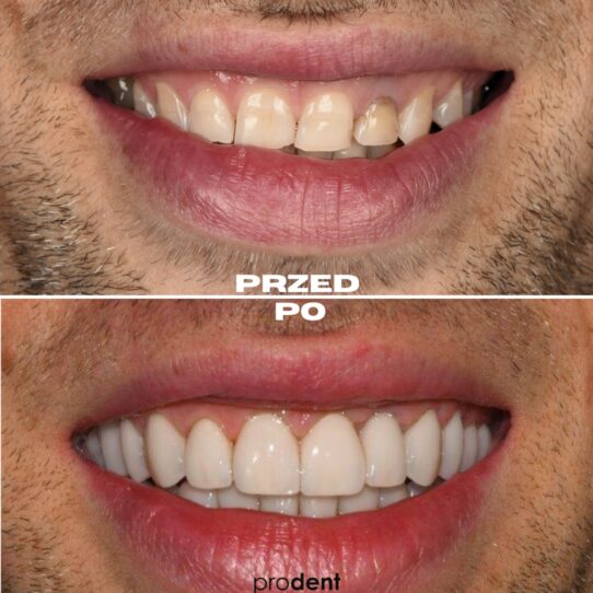 metamorfoza 12 prodent