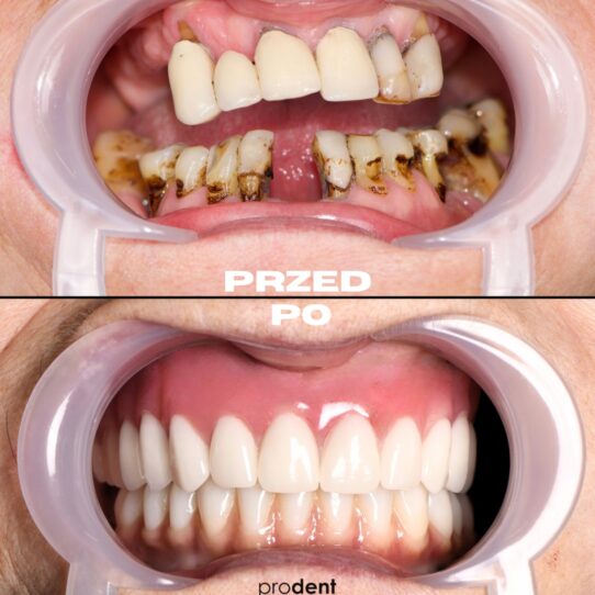 metamorfoza 6 ProDent