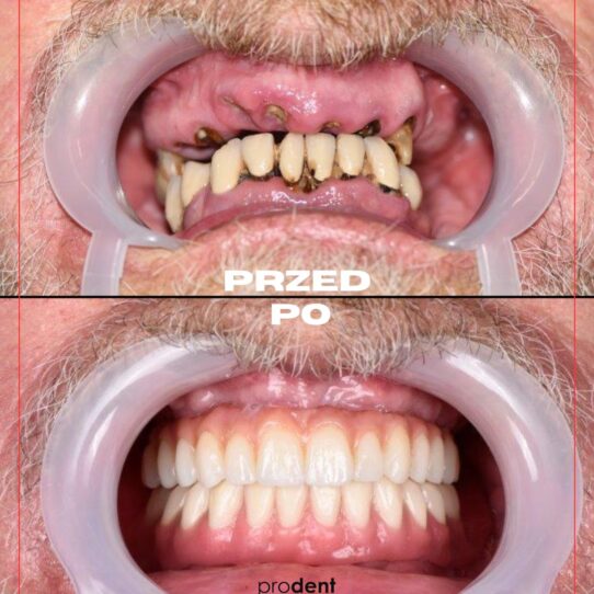 metamorfoza prodent 7