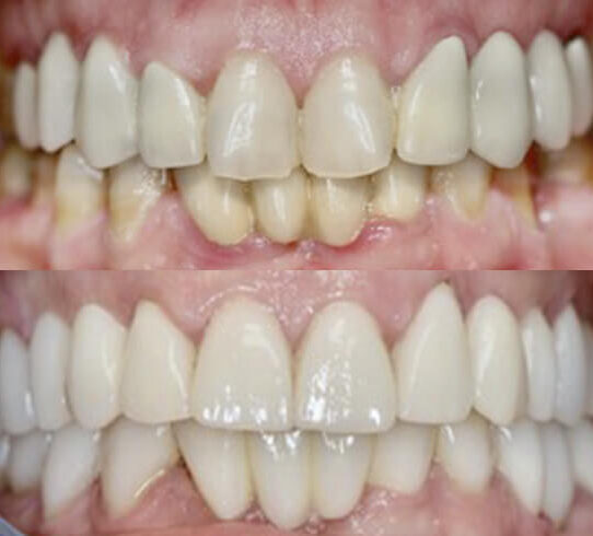 wymiany starych mostów porcelanowych na nowe i wykonania pięknych licówek porcelanowych