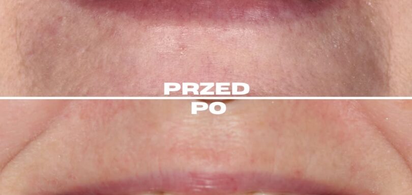 Case study kompleksowej odbudowy na implantach w Gdańsku – metamorfoza uśmiechu przed i po leczeniu implantologicznym oraz protetycznym.