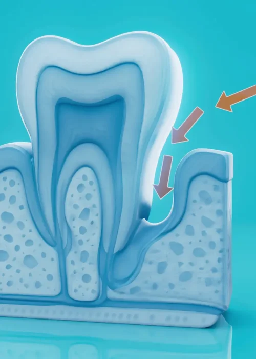 Periodontologia Gdańsk | Leczenie parodontozy i chorób dziąseł Leczenie parodontozy Gdańsk – grafika przedstawiająca cofanie dziąseł i zanik kości przy zębie