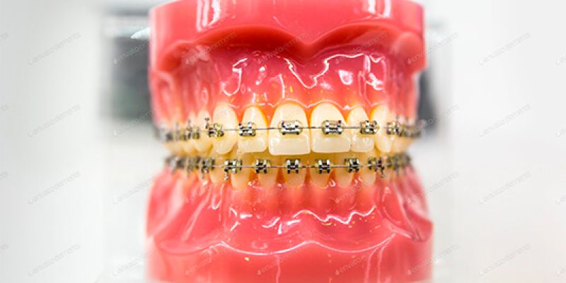 Ortodonta Gdańsk - leczenie wad zgryzu, czy warto?