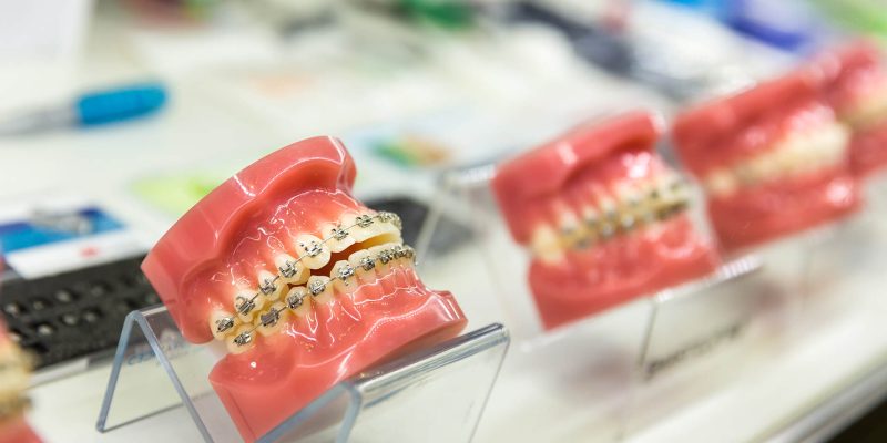 Leczenie ortodontyczne - aparat na zęby